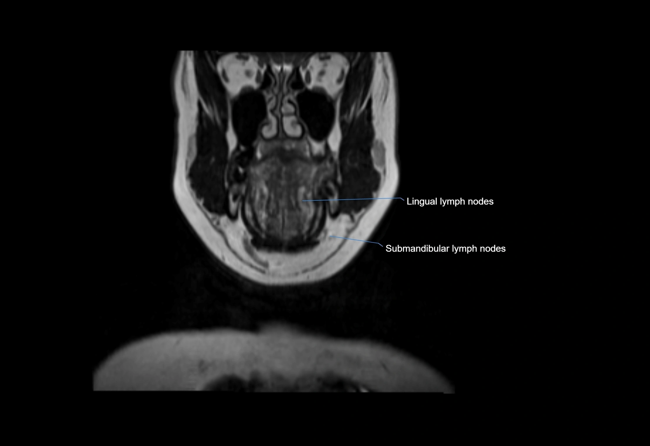 Neck coronal lymph node cross sectional MRI anatomy 3T MRI  image-img-00001-00057.webp